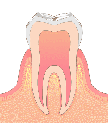 C0：初期段階の虫歯