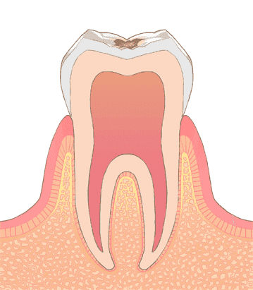 C1：エナメル質の虫歯
