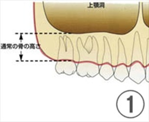 上顎の奥歯の上に空洞があります。健康な歯がある場合は骨の高さが保たれています。