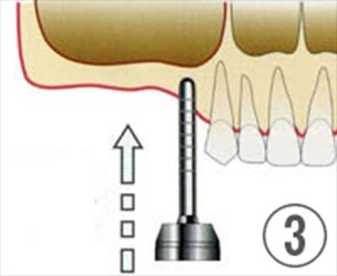 インプランターを使ってインプラント埋め込み用の穴を作り、特殊なソケットリフターを使って骨を押し上げます。