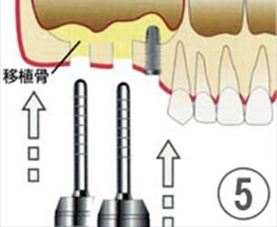 順次、インプランターを使って埋入ホールを形成し、人工骨による骨造成を行いインプラントを埋入していきます。