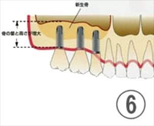 チタンで出来たインプラントと骨が強固に結合すること3〜6ヶ月後に人工歯冠を装着します。