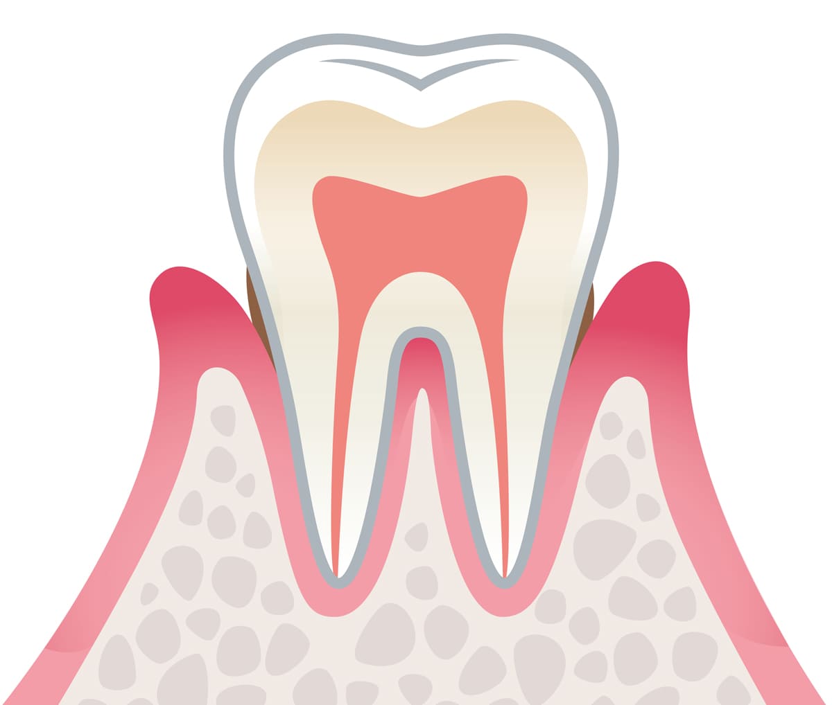 軽度歯周病