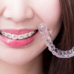 ワイヤー矯正とマウスピース矯正のイメージ