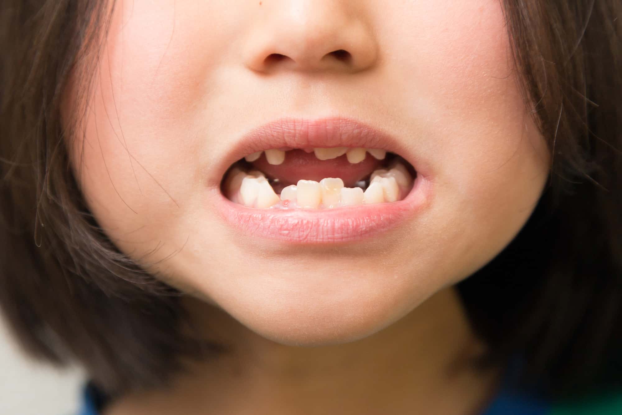 歯並びの悪い子どものイメージ