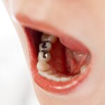 銀歯の下が虫歯になっている女性