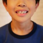 すきっ歯の子どもの歯