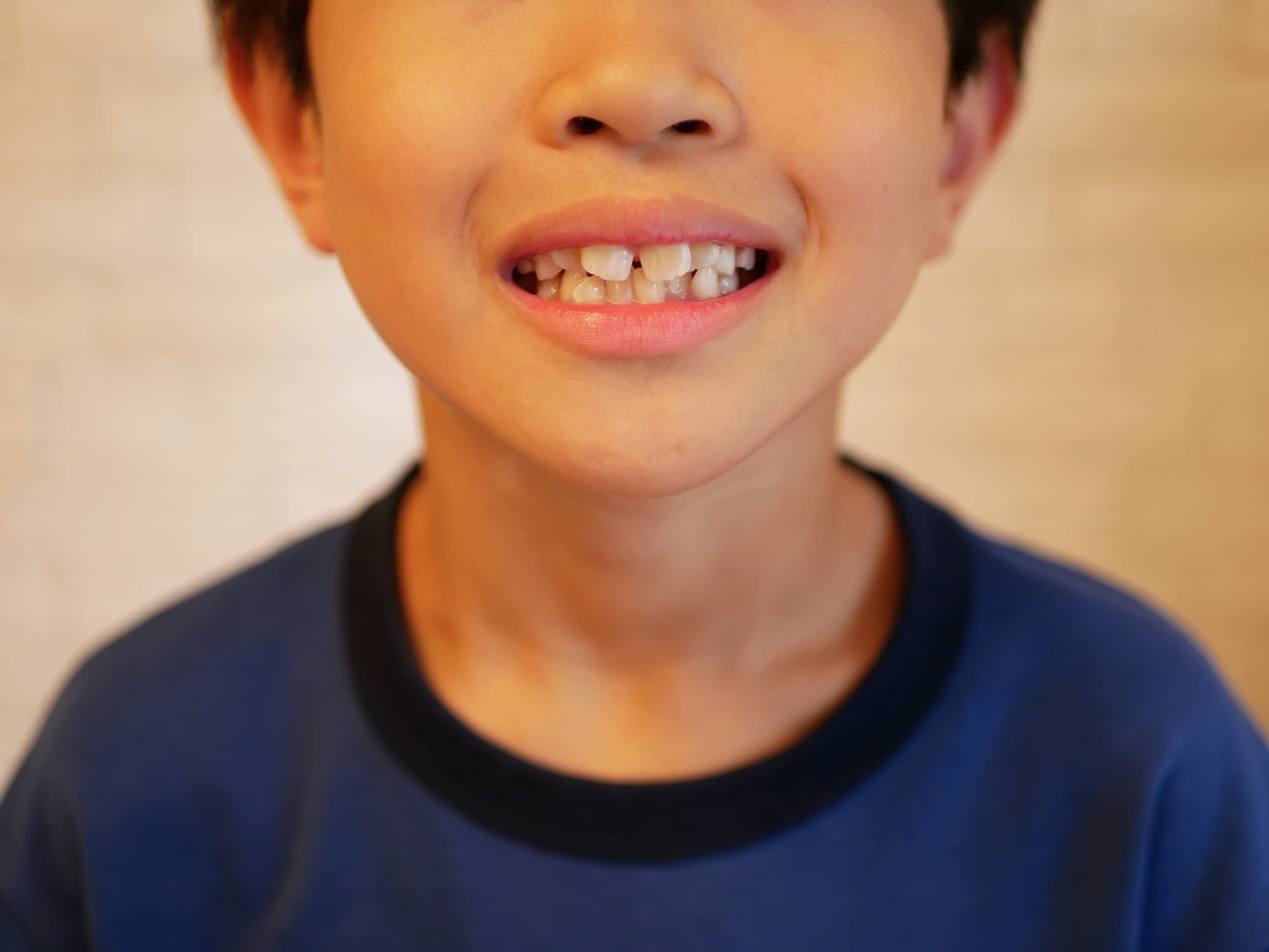 すきっ歯の子どもの歯