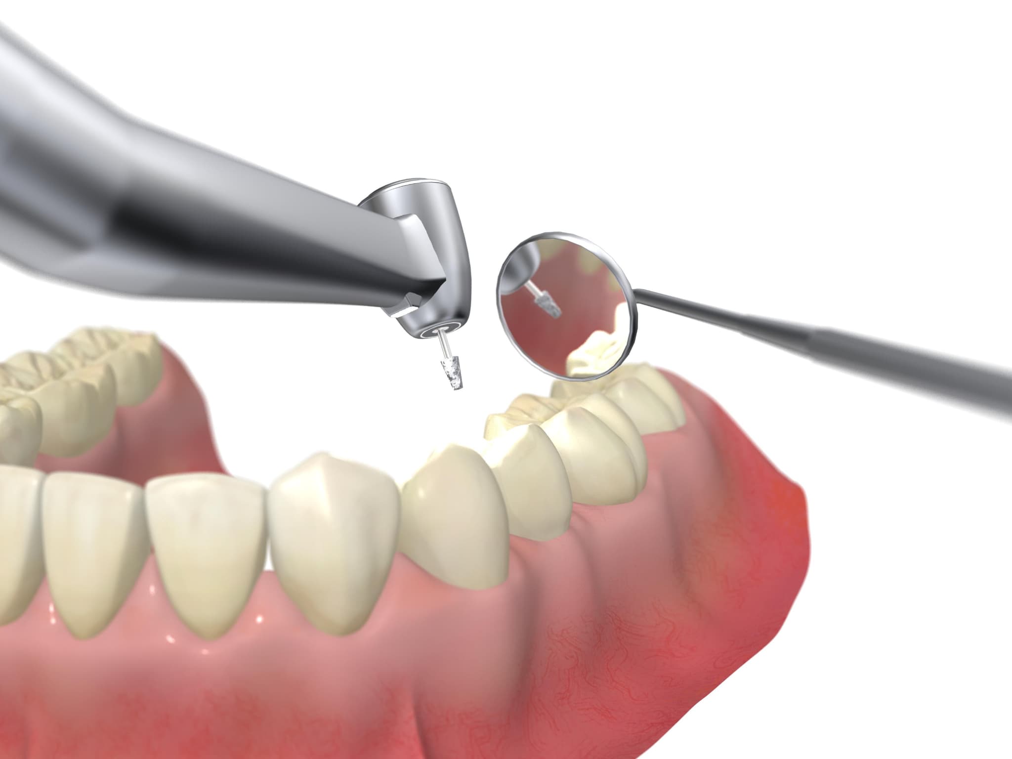 矯正治療で歯を削るイメージ