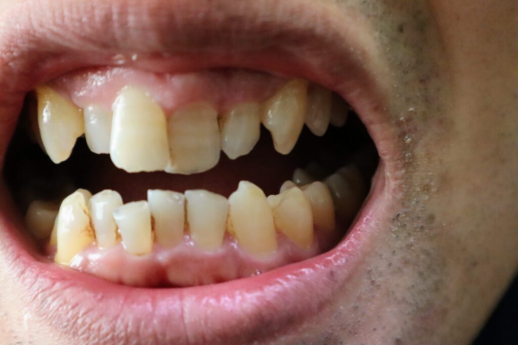 部分矯正で対応が難しい歯並びをしている男性