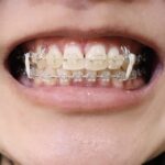 前歯の部分矯正をしている女性