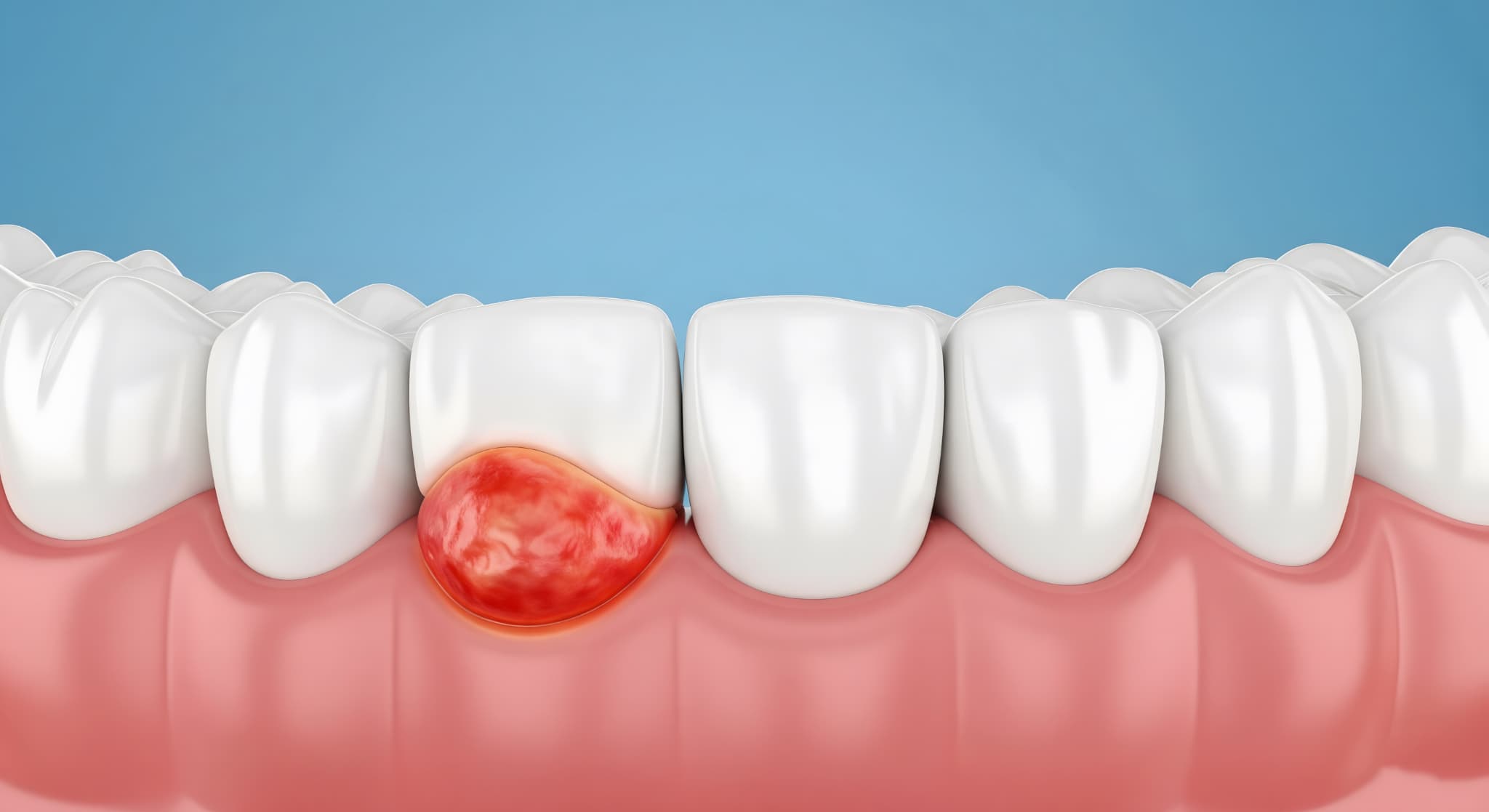 歯周病になって腫れた歯茎