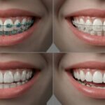 ワイヤー矯正やマウスピース矯正をしている口元の4つの画像