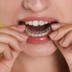 マウスピース矯正の装置が浮くのが気になり装置を触っているイメージ