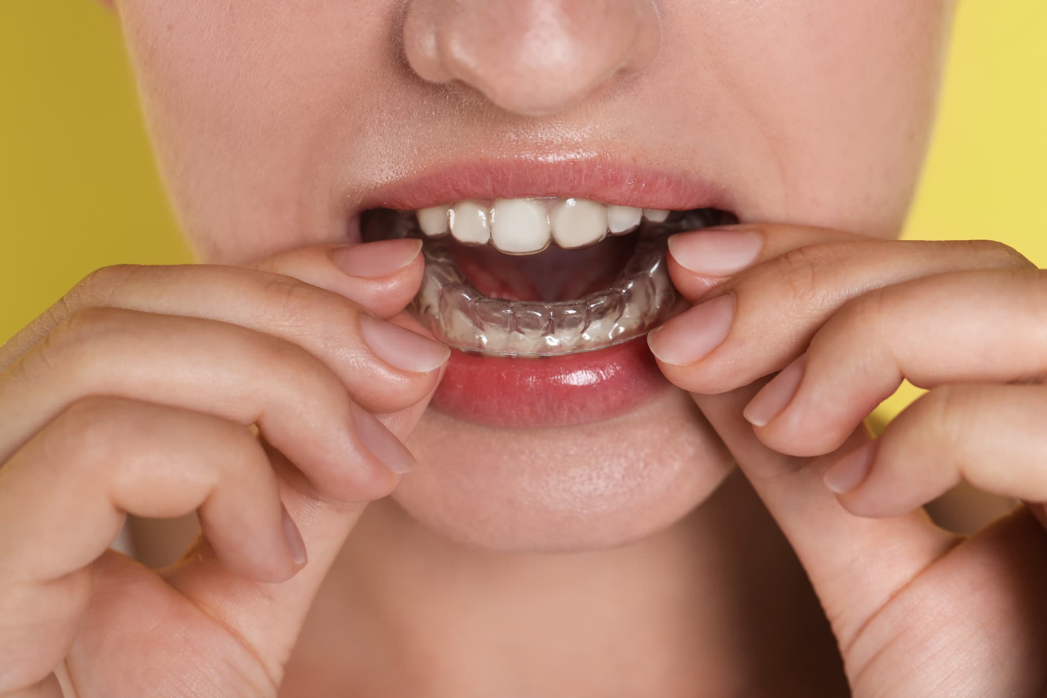 マウスピース矯正の装置が浮くのが気になり装置を触っているイメージ