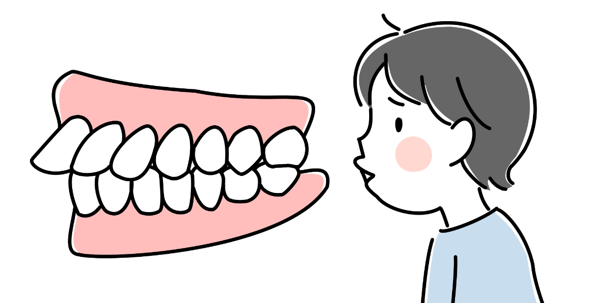 床矯正の適応症例である出っ歯の子どもの歯