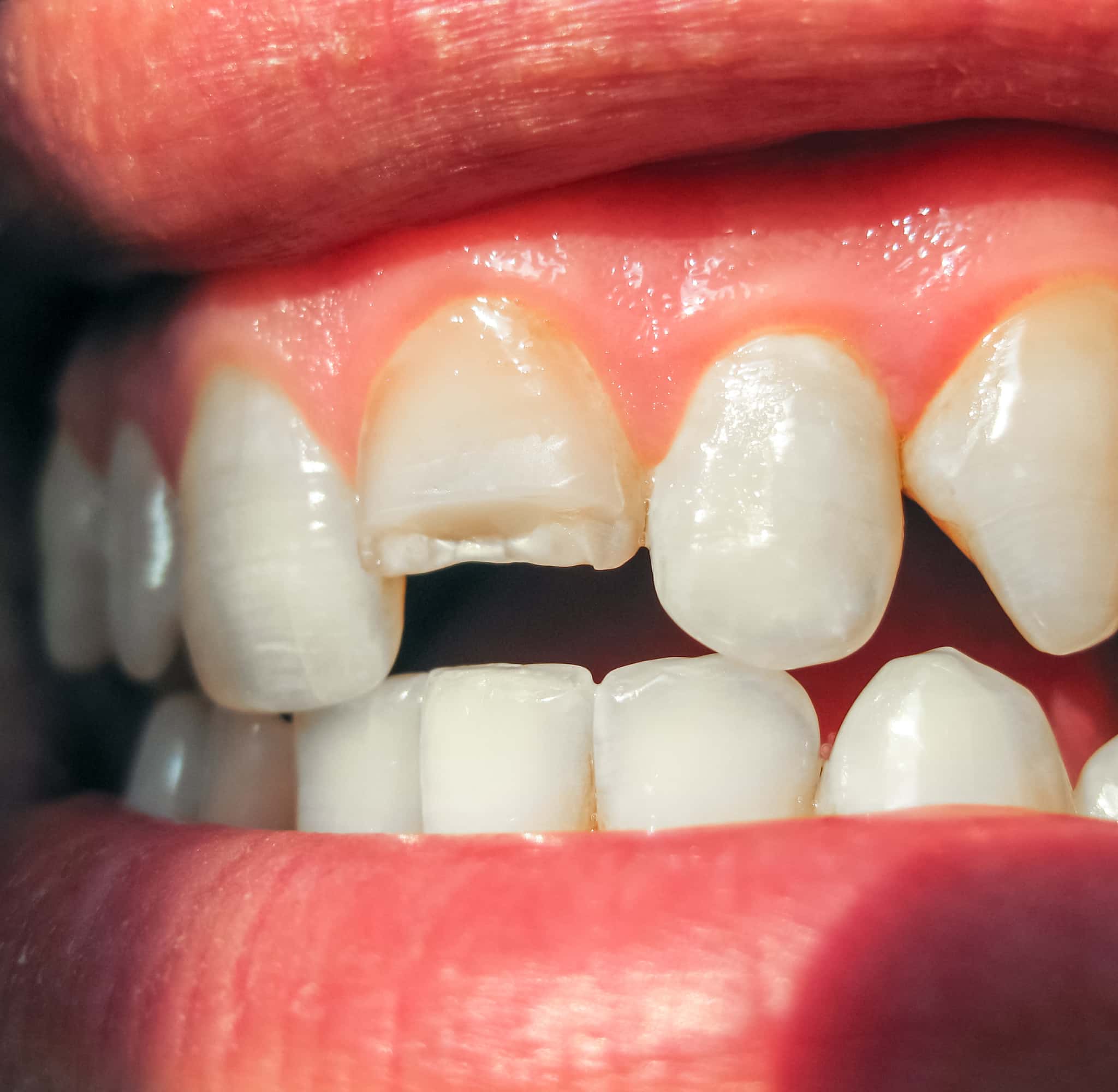 歯ぎしりが原因で破損した歯