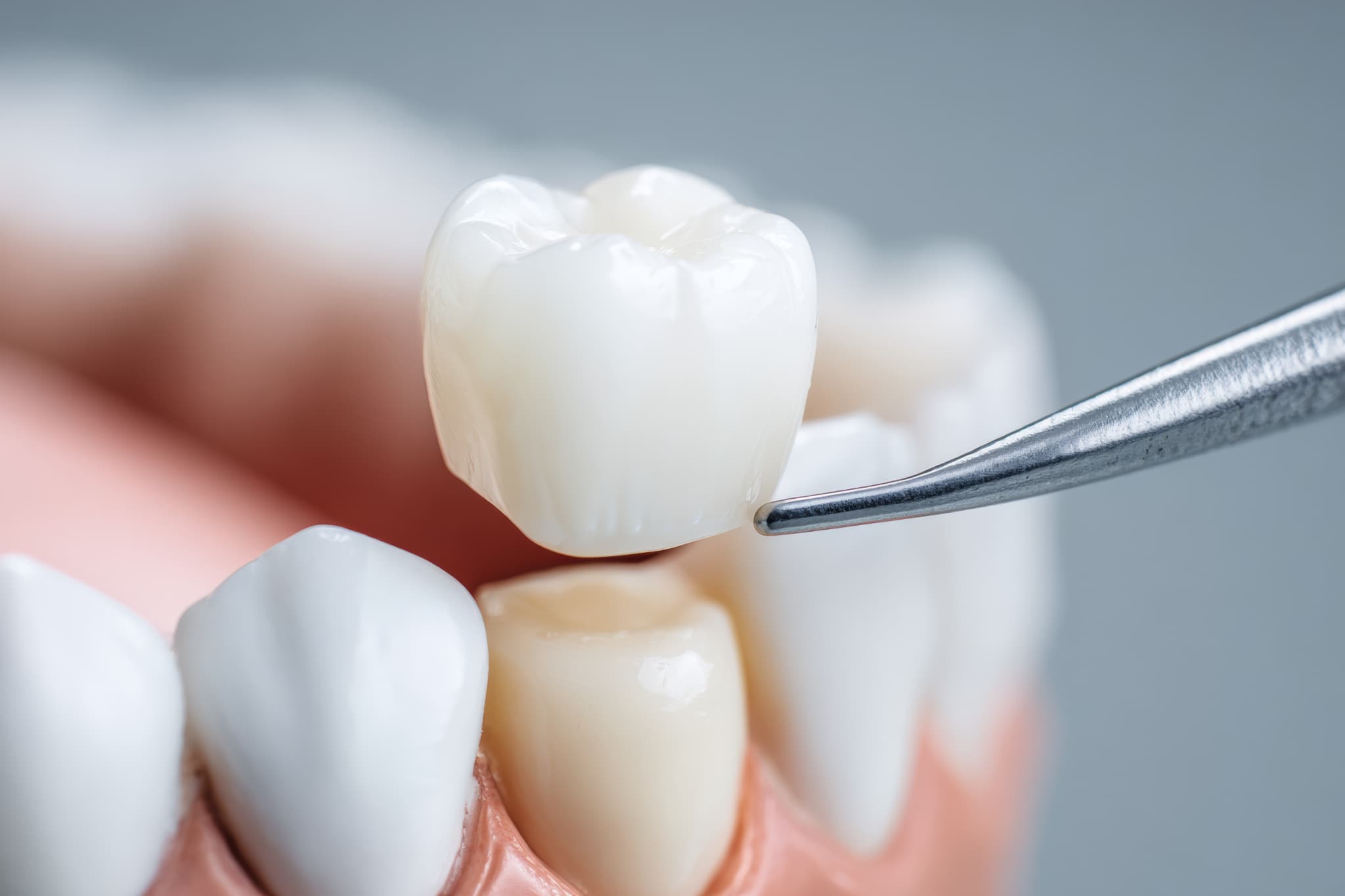 セラミッククラウンで歯を白くする様子