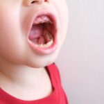 1期の小児矯正が必要な子ども