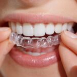 八重歯をマウスピース矯正をした人