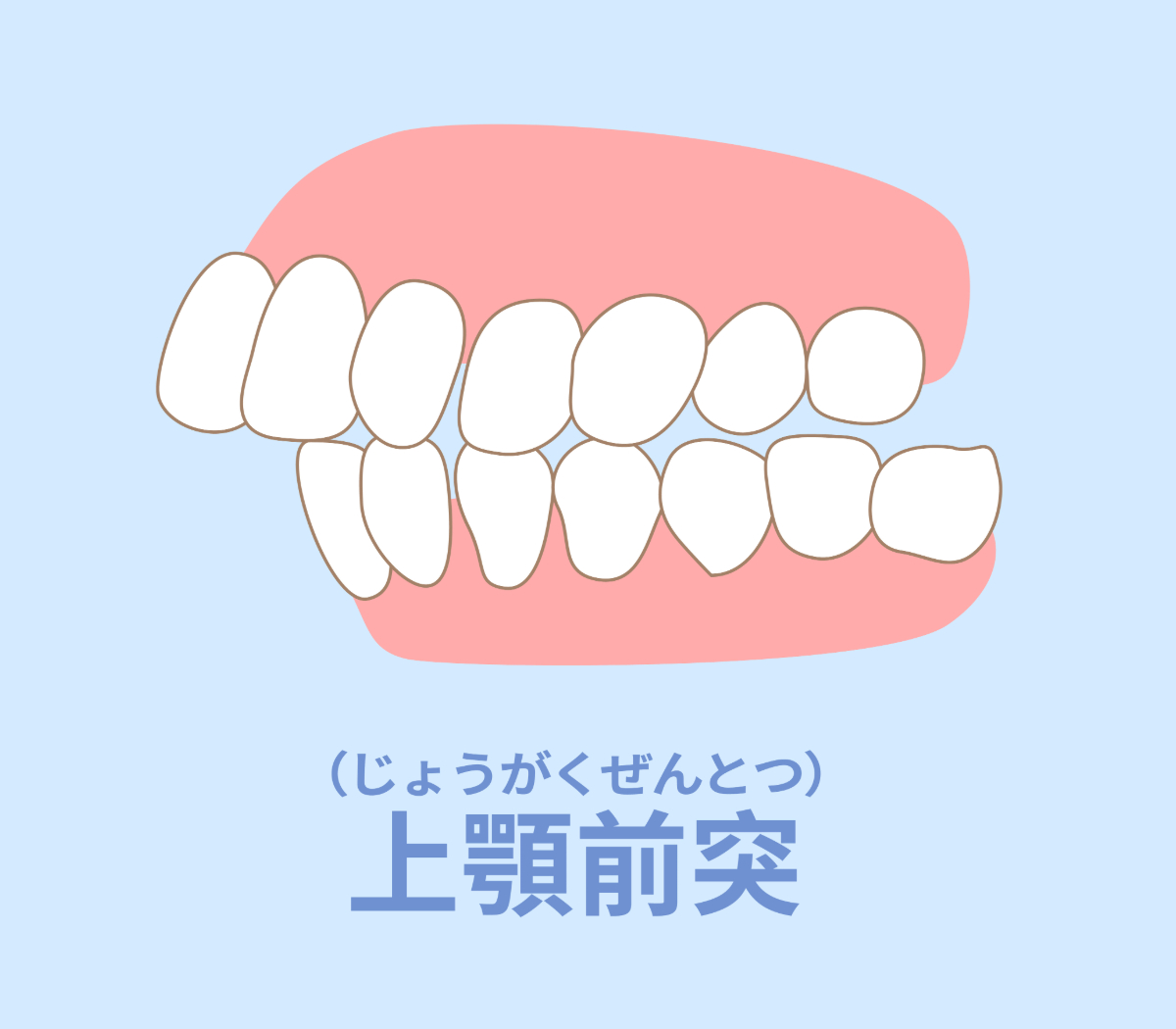 歯並びが悪い出っ歯の構造